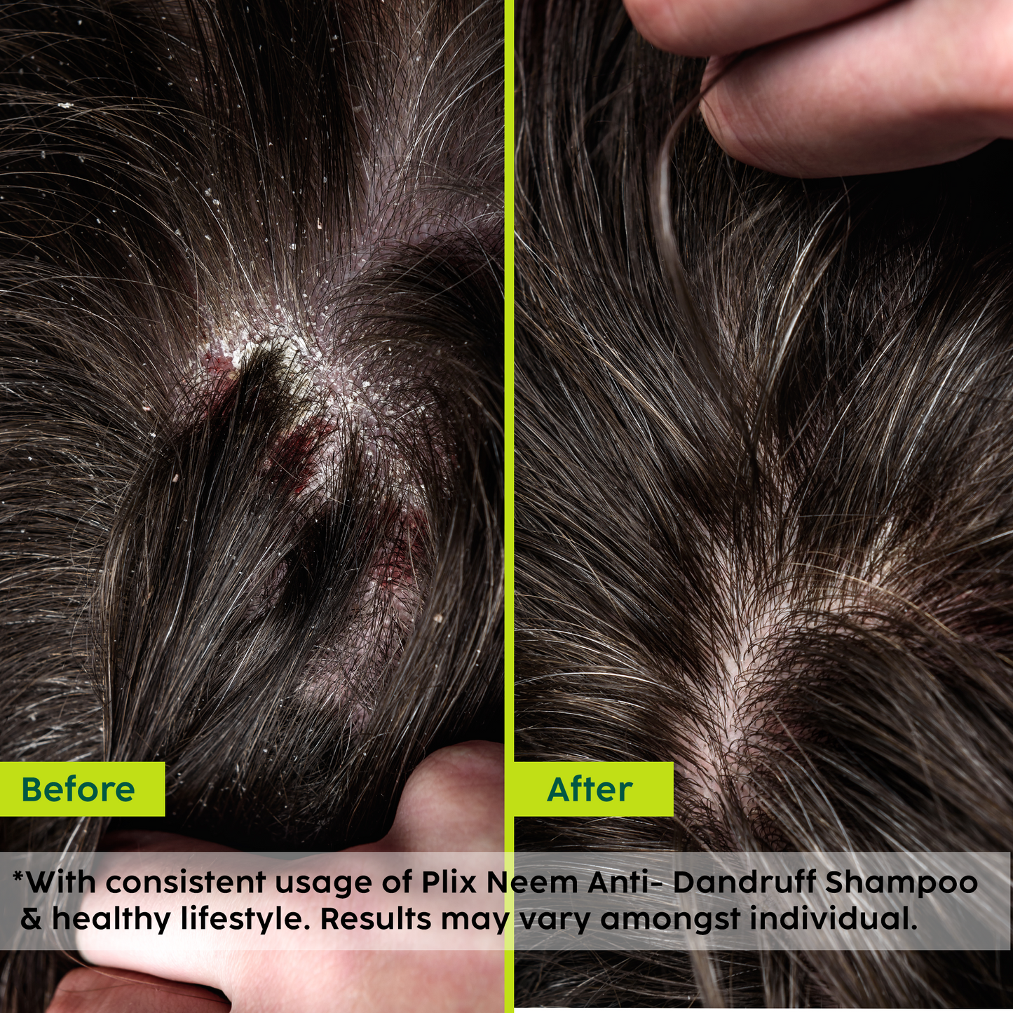 Neem Advanced Anti-Dandruff Conditioner